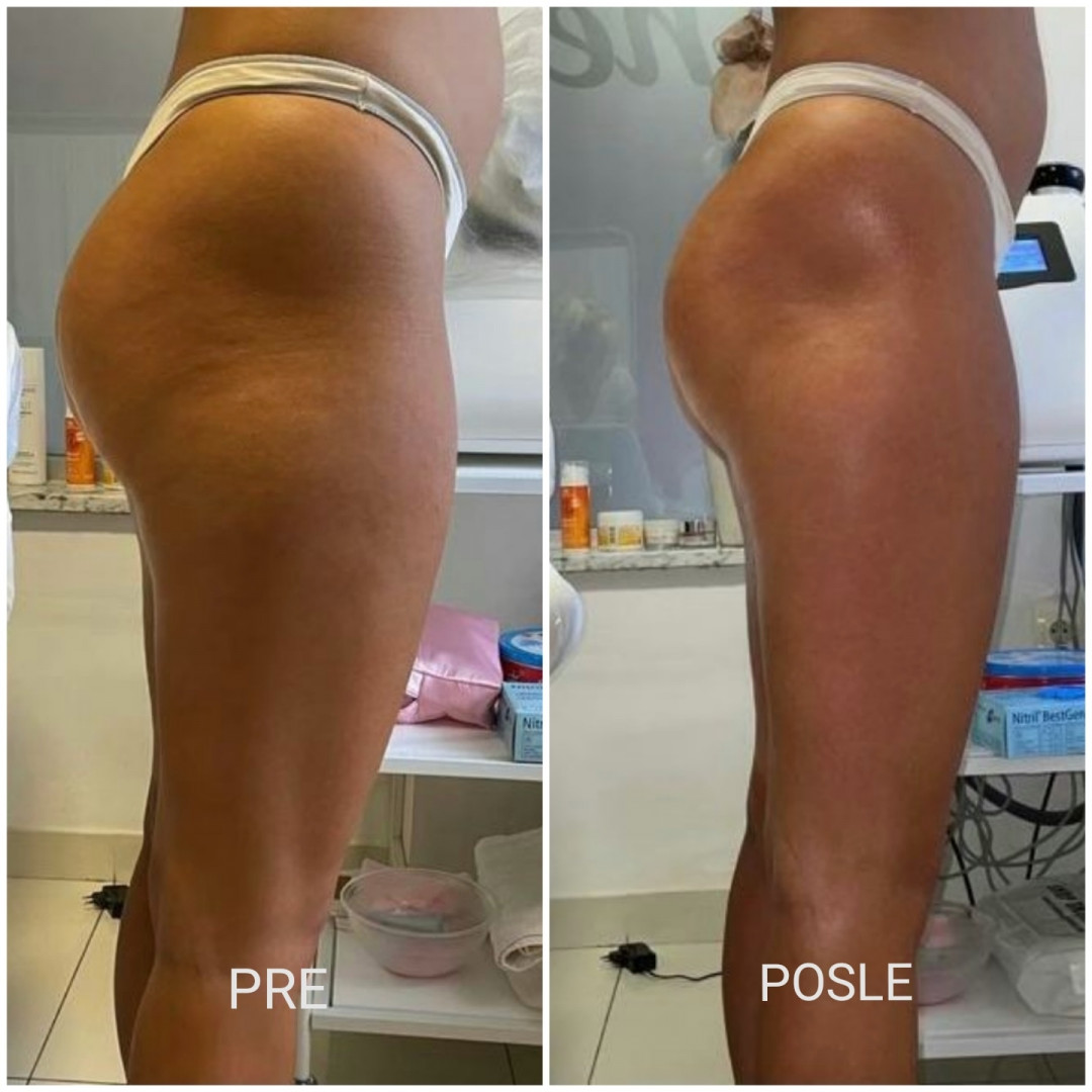 Lipolaser Centar - Matrix021 #novisad Tretmani tela