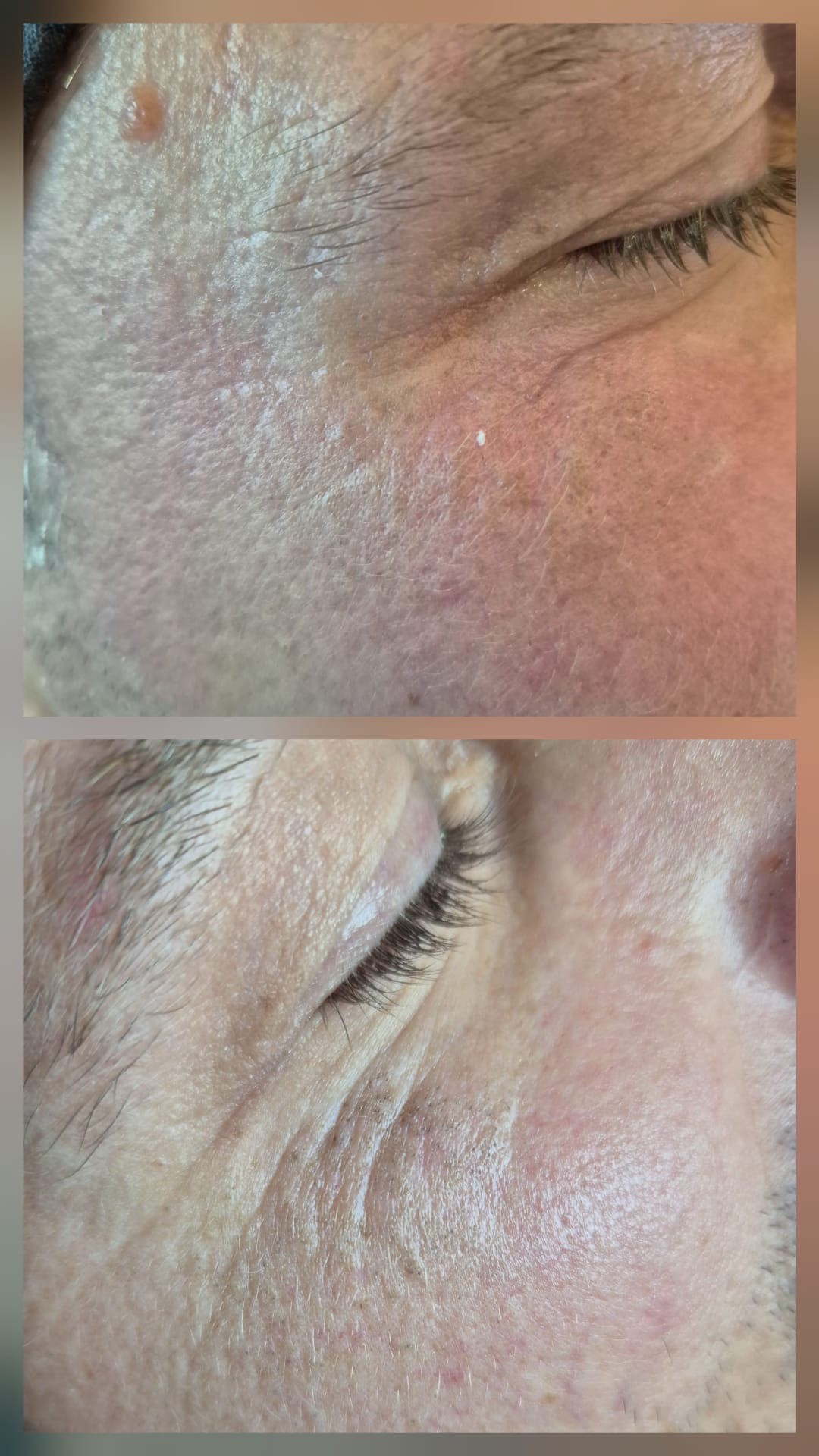 Mila Beauty Centar #beograd Tretman lica Ultrazvuk + koktel - po tipu kože