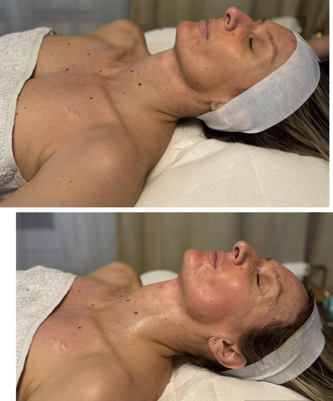 Beauty and nutrition #beograd Lifting / zatezanje kože DIVINE Face masaža lica po metodi Manuele Shale