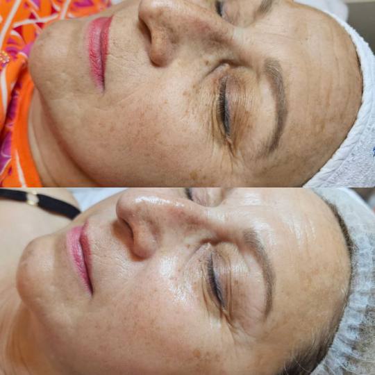 Choco Love #beograd Dermaroler i dermapen Dermapen tretman + Hemijski piling