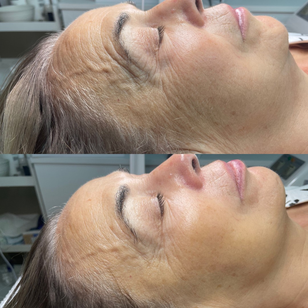 ReNova nutri & beauty #beograd Tretman lica Biološki antiage tretman lica
