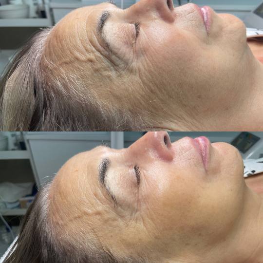 ReNova nutri & beauty #beograd Tretman lica Biološki antiage tretman lica Namenjen 30+, u ponudi im