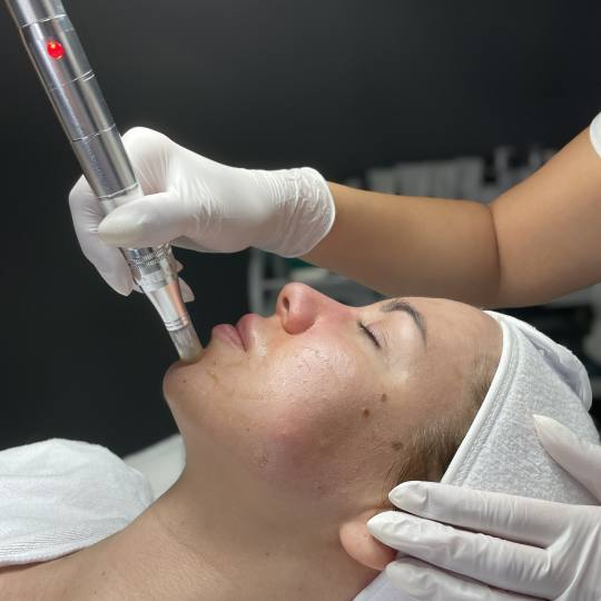 Monika Barta Cosmetics #novisad Dermaroler i dermapen Dermapen tretman lica