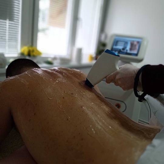 Krasiva 2 #beograd Laserska epilacija Laserska epilacija leđa + ramena - za muškarce
