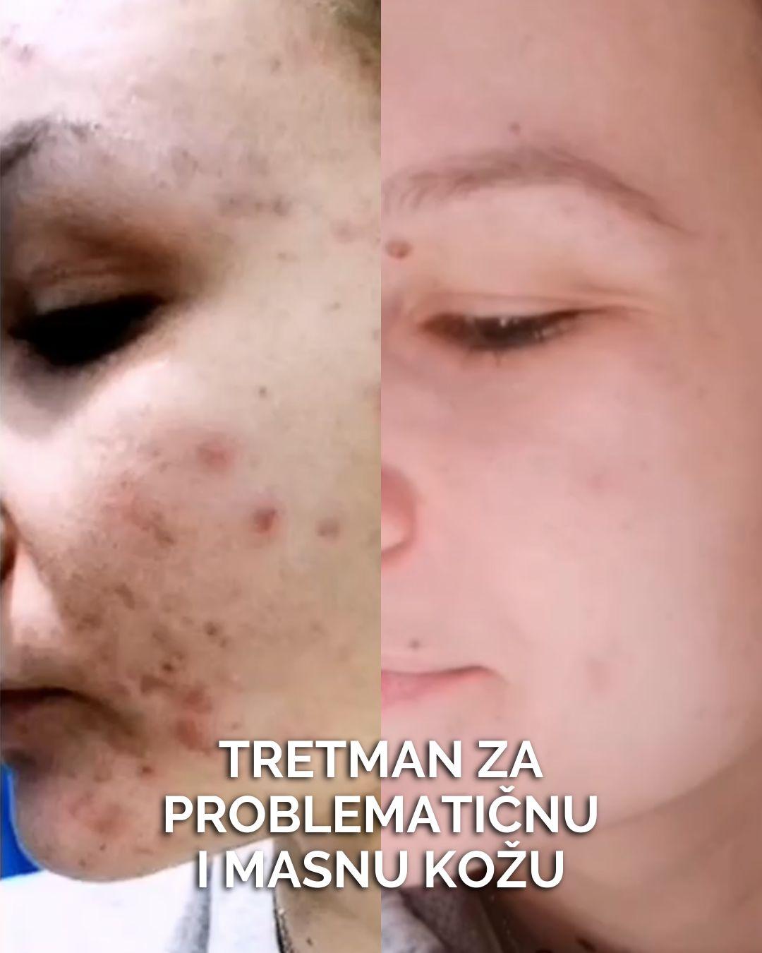 Tretman problematične kože lica - Natural Beauty Lux, Beograd Tretman lica Lice Tretman lica, Beograd, Bežanijska kosa, Bežanija, Ledine, Surčin