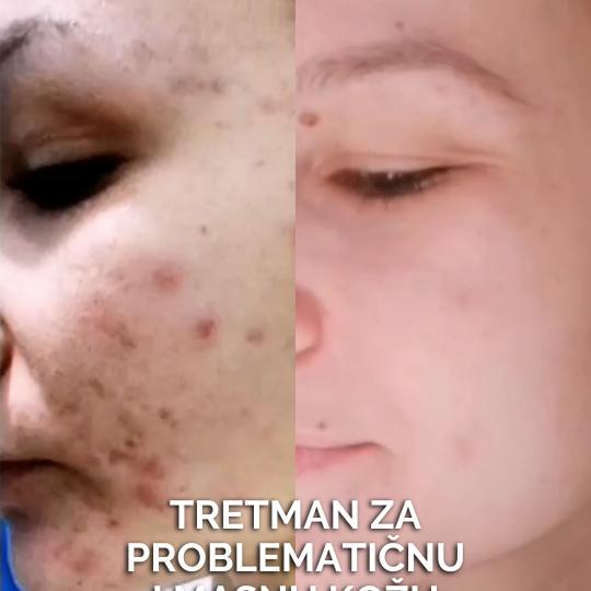 Natural Beauty Lux #beograd Tretman lica Tretman problematične kože lica Autorski tretman namenjen