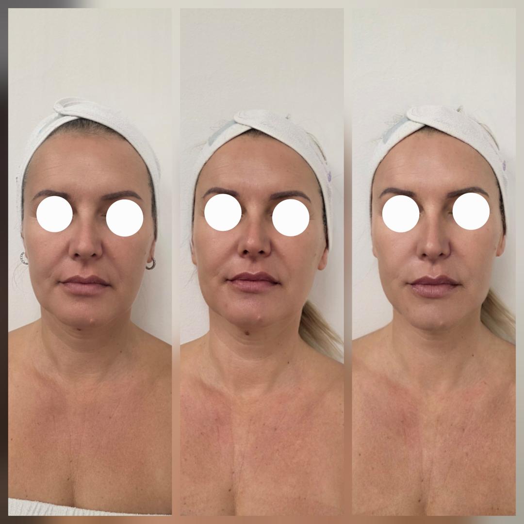 Beauty Vreme za mene #novisad Tretman lica Higijenski tretman lica+Hidralift HIFU tretman+Oxygen tretman