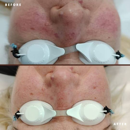 MediBella Aesthetic Dedinje #beograd Laserski tretmani lica Lasersko lečenje rozacee Terapije laser