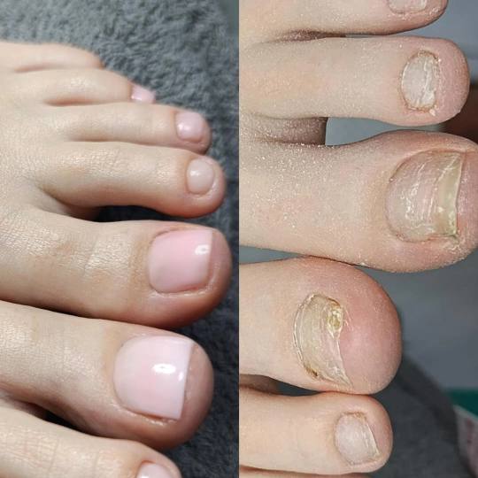 Hellena Cosmetics #novisad Medicinski pedikir Medicinski pedikir + gel lak - Zdravlje i stil