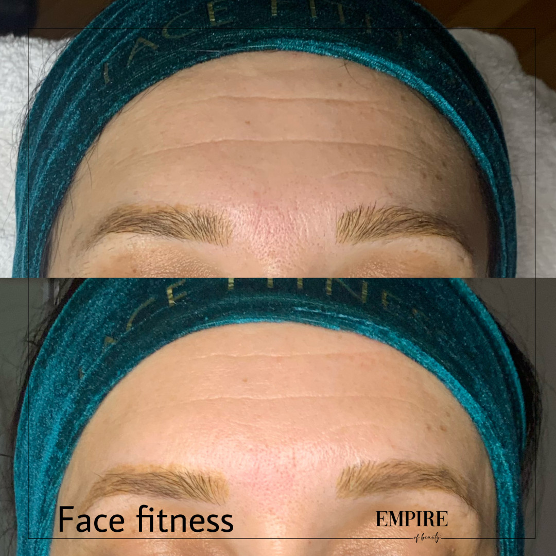 Guardian Beauty Centar & Milica Tepavac #beograd Tretmani protiv bora Face fitnes ventuzama + maska