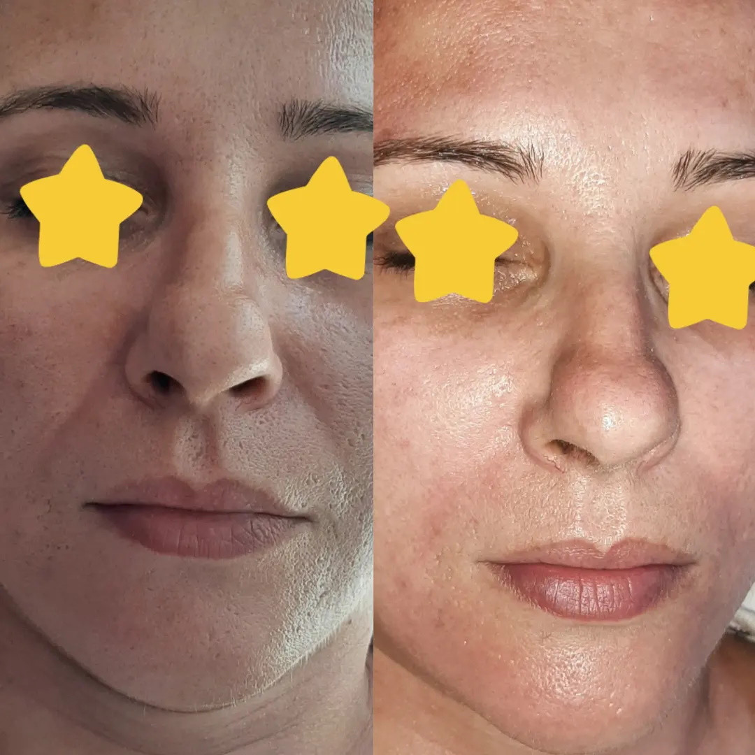 Elin Sary Mary Kutak #beograd Medicinski pedikir Derma Fix tretman lica sa kolagenskim nitima - paket od 3 tetmana