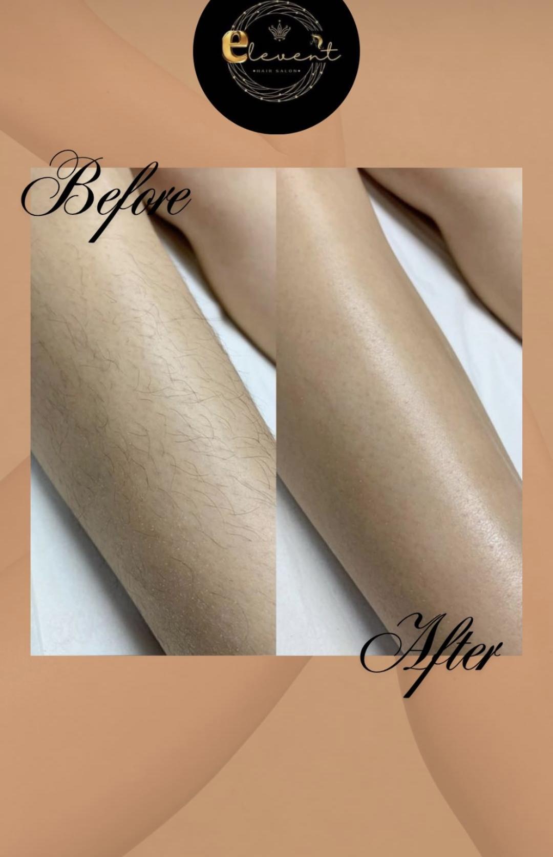 Elevent #beograd Laserska epilacija Laserska epilacija celog tela - za dame