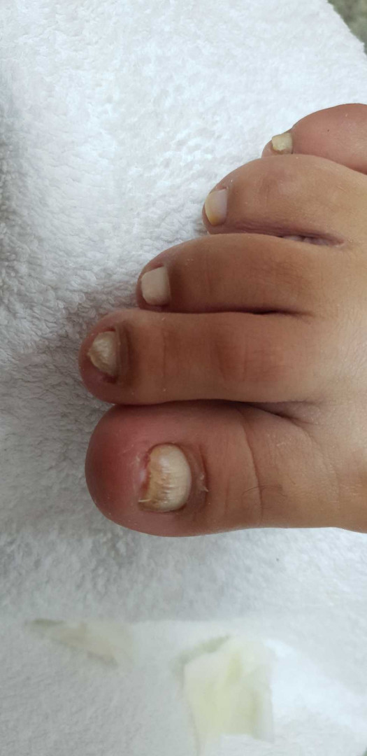 Tina B #beograd Medicinski pedikir Medicinski pedikir - gljivični / oboleli nokti