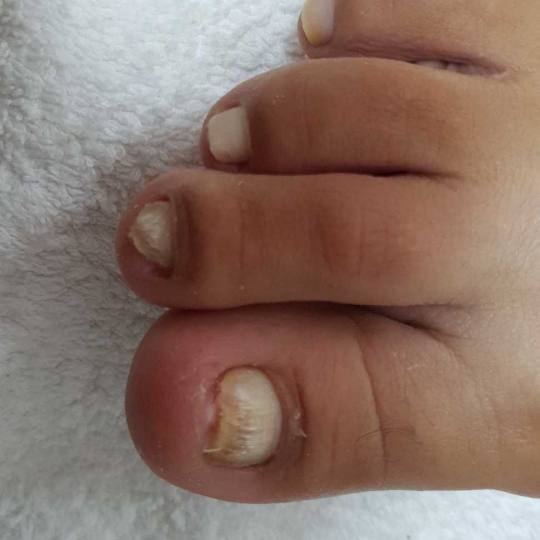 Tina B #beograd Medicinski pedikir Medicinski pedikir - gljivični / oboleli nokti