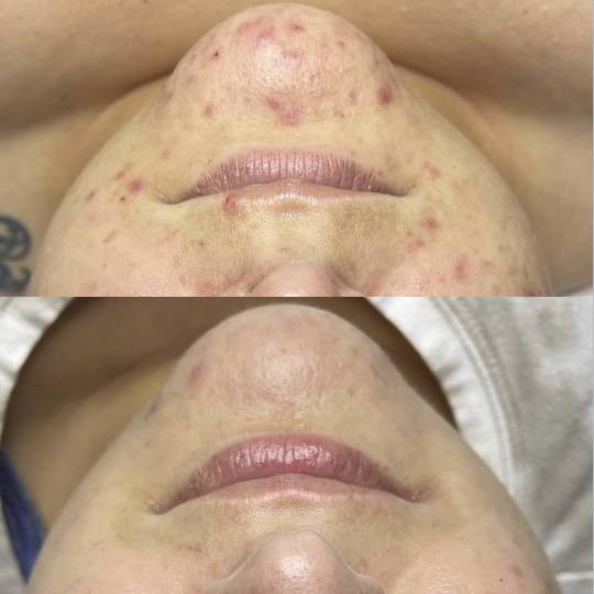 SkinLab Beauty Centar #novisad Tretman lica AzAc hemisjki piling Hvala AzAc hemijskim pilingu ✨

