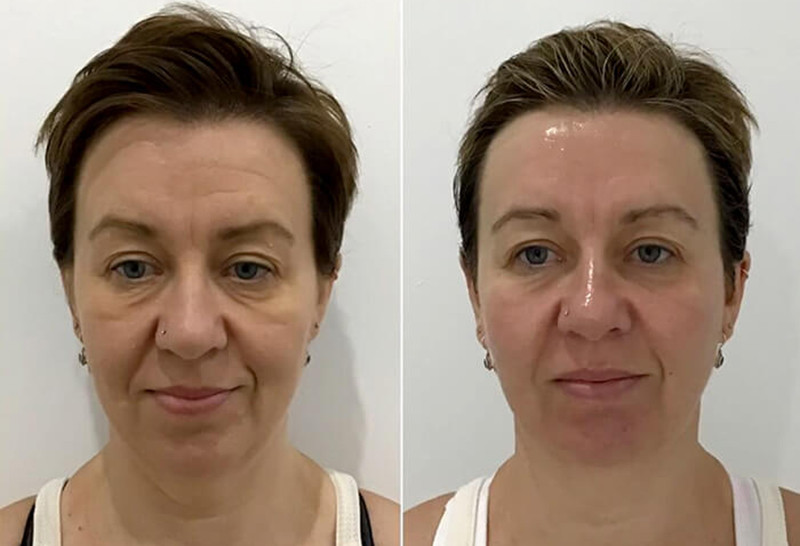 Beauty and me #novisad Lifting / zatezanje kože HIFU SMAS 7D - lice (nehirurški lifting lica bez vrata)