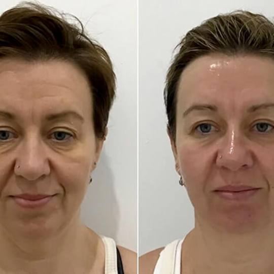 Beauty and me #novisad Lifting / zatezanje kože HIFU SMAS 7D - lice (nehirurški lifting lica bez v