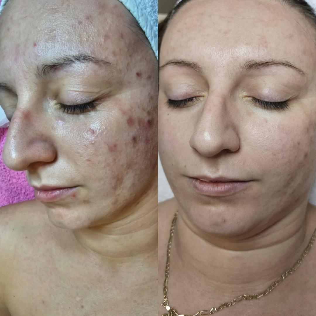 Choco Love #beograd Tretman lica Higijenski tretman lica + hemijski piling