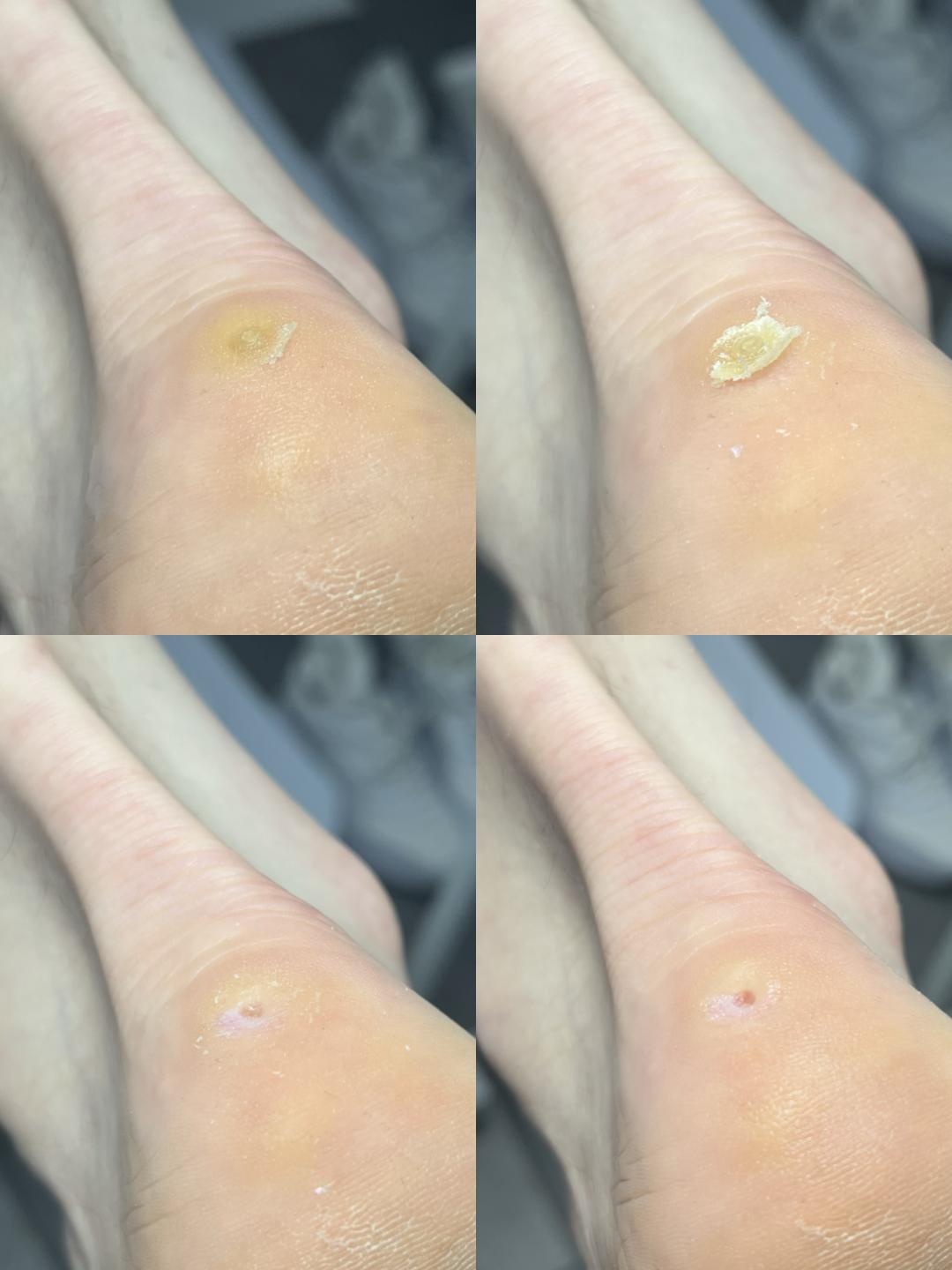 Touch Aesthetic&Medical care #beograd Medicinski pedikir Kurje oko sa korenom