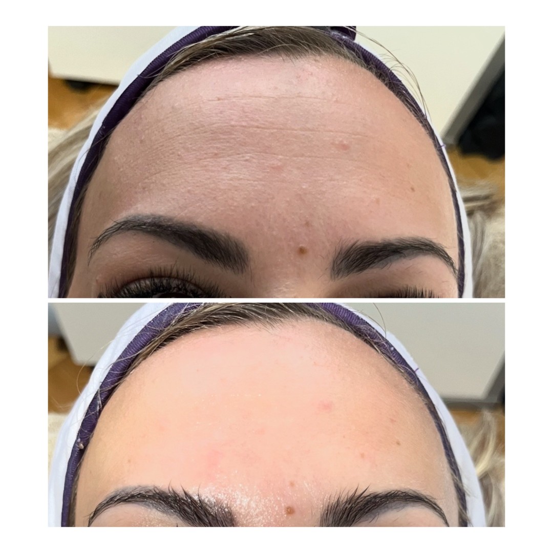 Xenija Beauty Room #beograd Tretman lica Hemijski piling lica