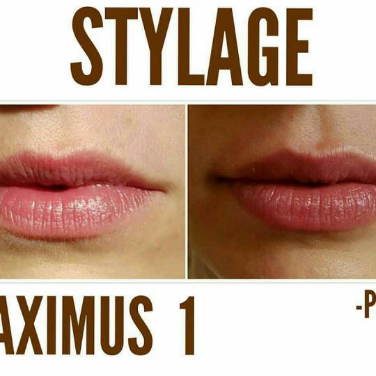 Maximus 1 #nis Hijaluronski tretmani lica Korekcija usana Hijaluronski fileri (1 ml)