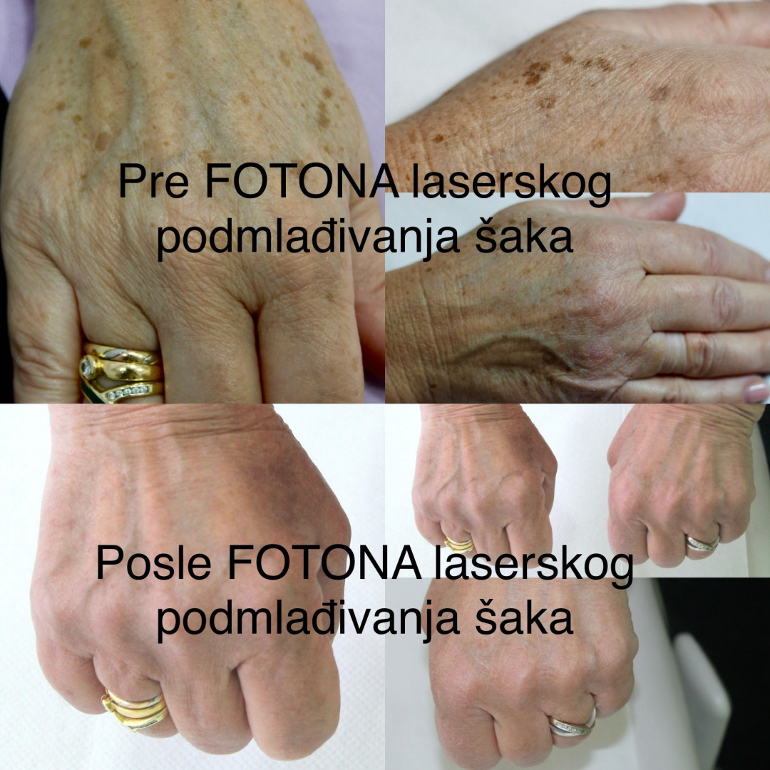 Poliklinika Marić #novisad Tretman lica Laserski tretman podmlađivanja šaka