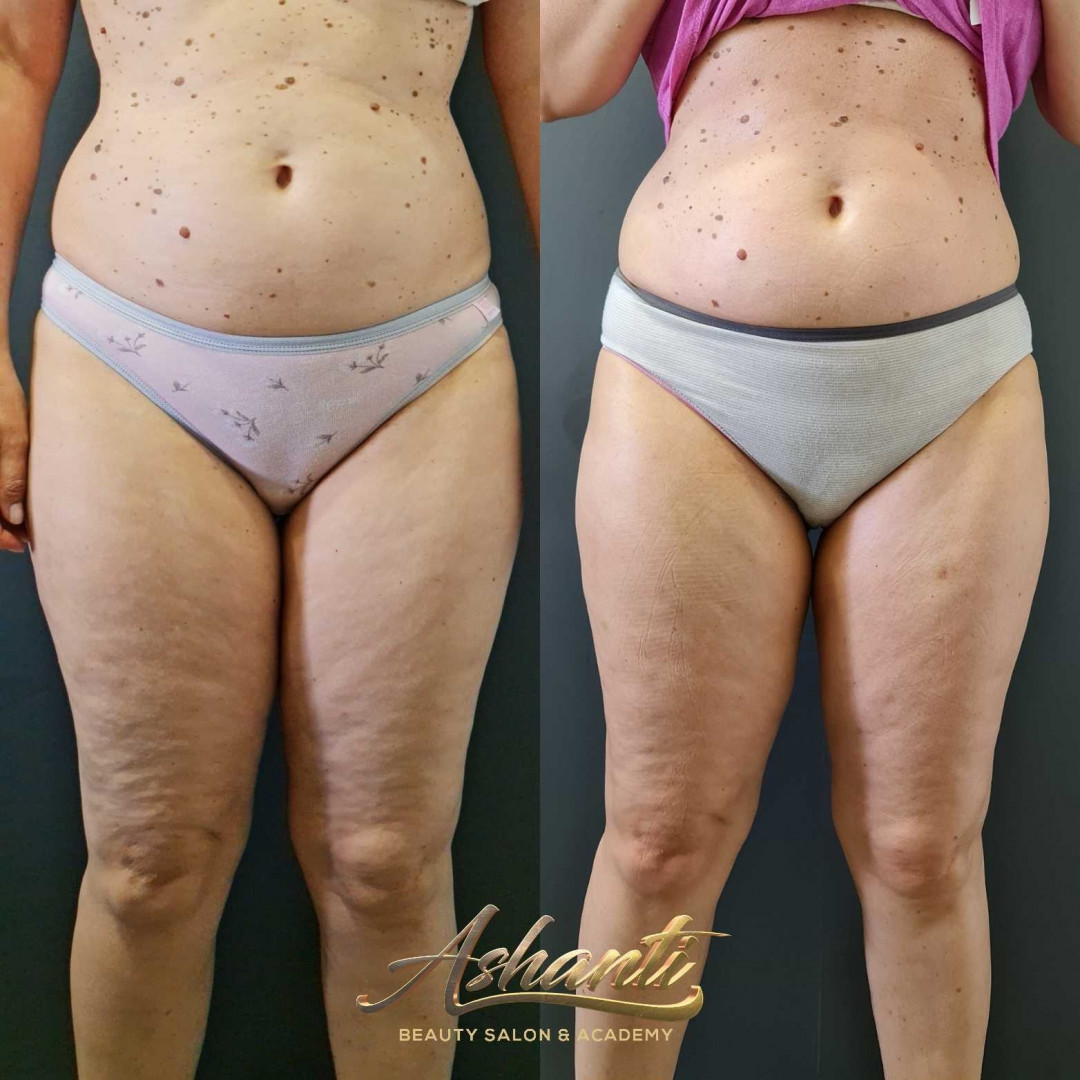 Ashanti Beauty Salon & Academy #beograd Masaža za mršavljenje Dermapen - regija lica