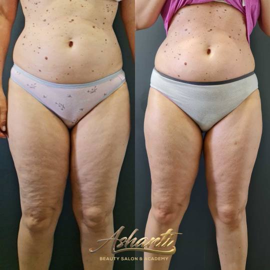 Ashanti Beauty Salon & Academy #beograd Masaža za mršavljenje Dermapen - regija lica