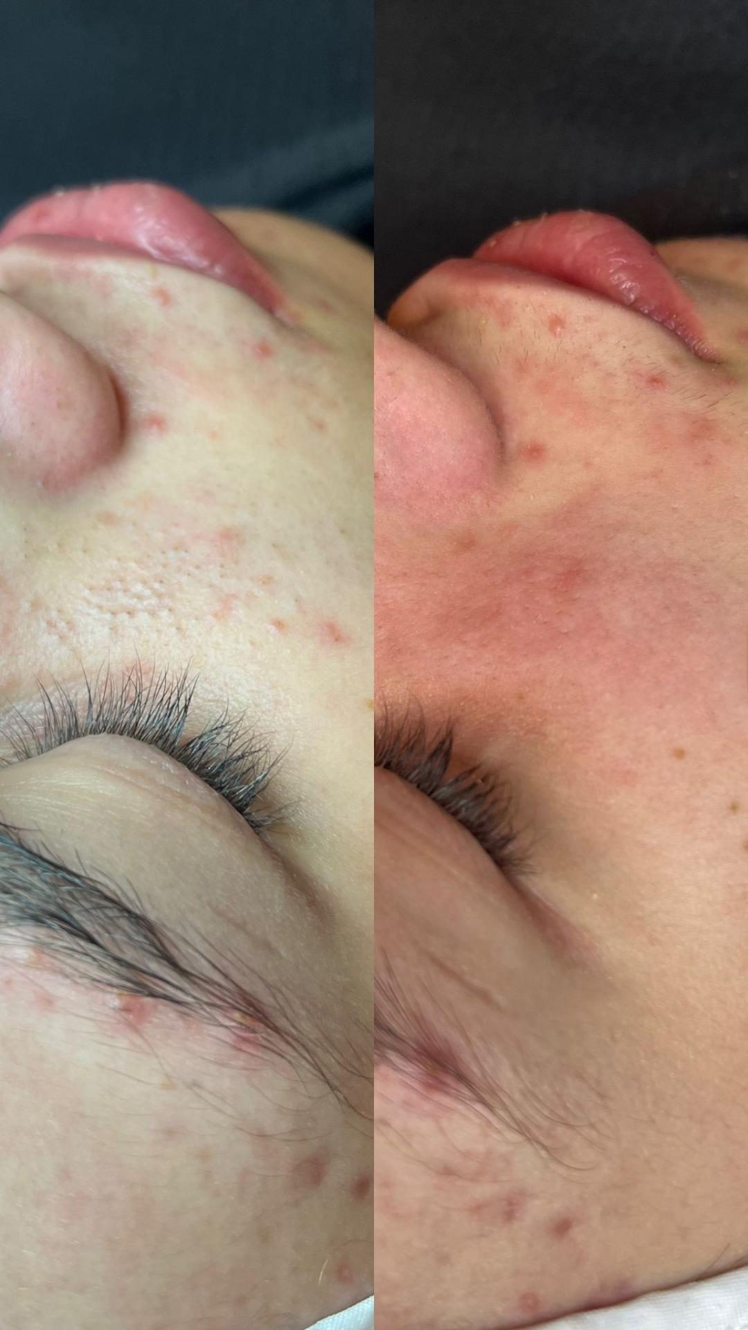 Laser centar Virgo #beograd Tretman lica Higijenski tretman lica + mikrodermoabrazija + led terapija