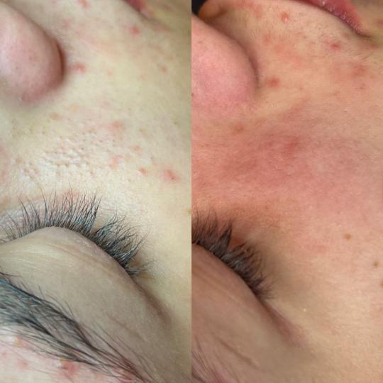 Laser centar Virgo #beograd Tretman lica Higijenski tretman lica + mikrodermoabrazija + led terapija