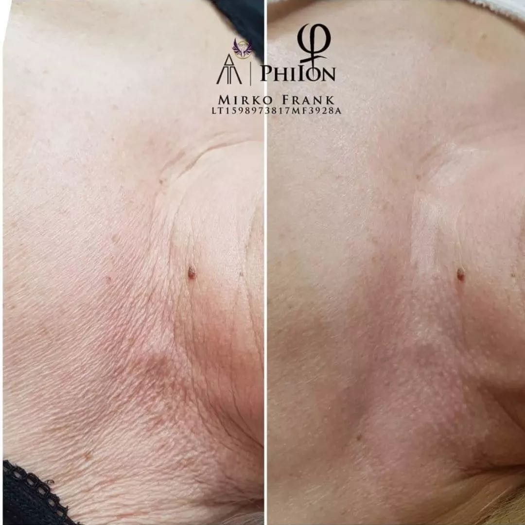 Lepa bez šminke #novisad Radiotalasni i ultrazvučni tretmani Philion nehirurška metoda - Uklanjanje strija sa stomaka i većih površina