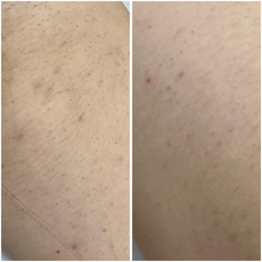 Belle Ana #beograd Laserska epilacija Laserska epilacija celih nogu - za dame Uklonite dlačice traj