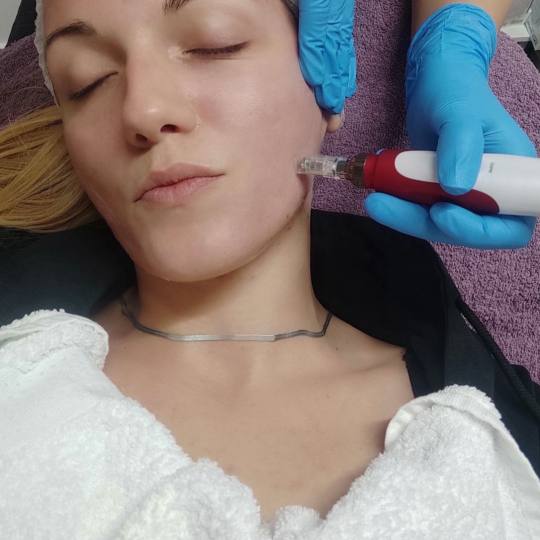 Lucia J&D #beograd Dermaroler i dermapen