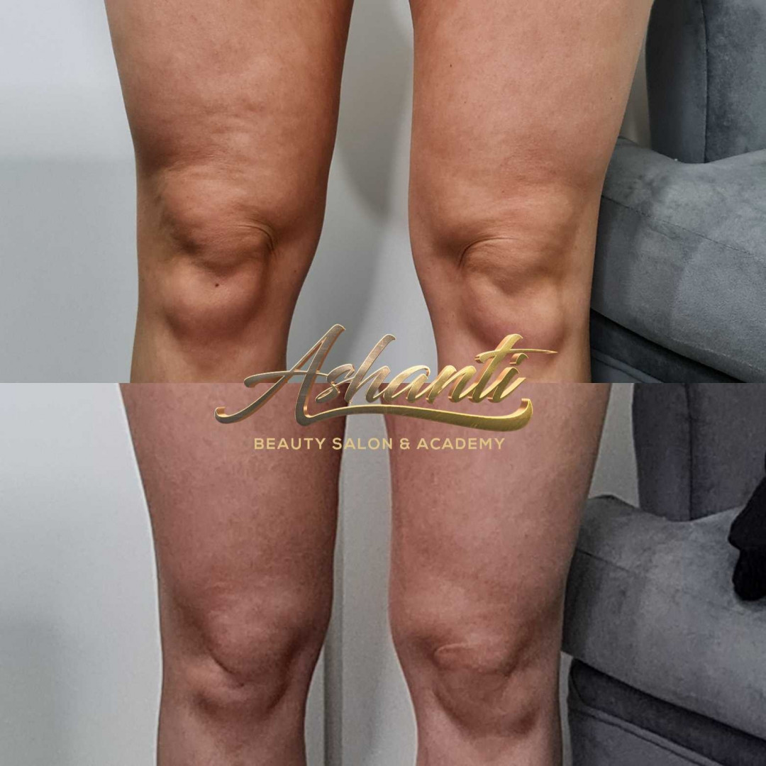 Ashanti Beauty Salon & Academy #beograd Kavitacija Ultrazvučna kavitacija - po regiji