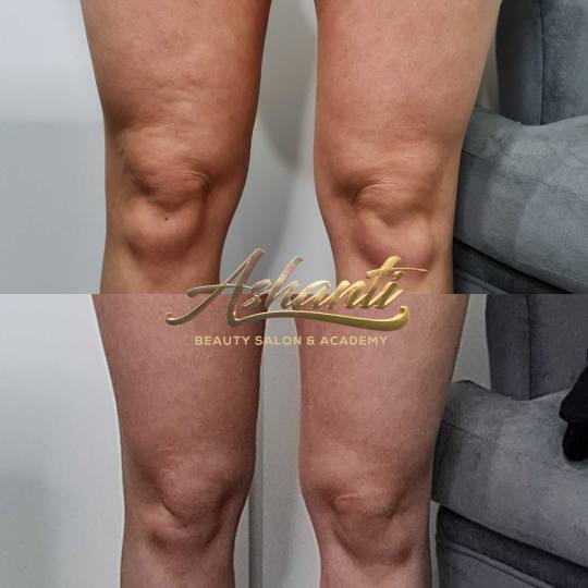 Ashanti Beauty Salon & Academy #beograd Kavitacija Ultrazvučna kavitacija - po regiji