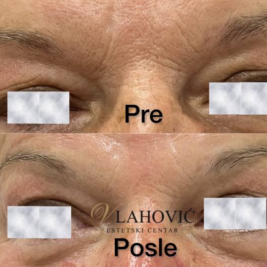 Estetski centar Vlahović #beograd Tretman lica HYDRAFACIAL - regeneracija i rejuvenacija kože Slik