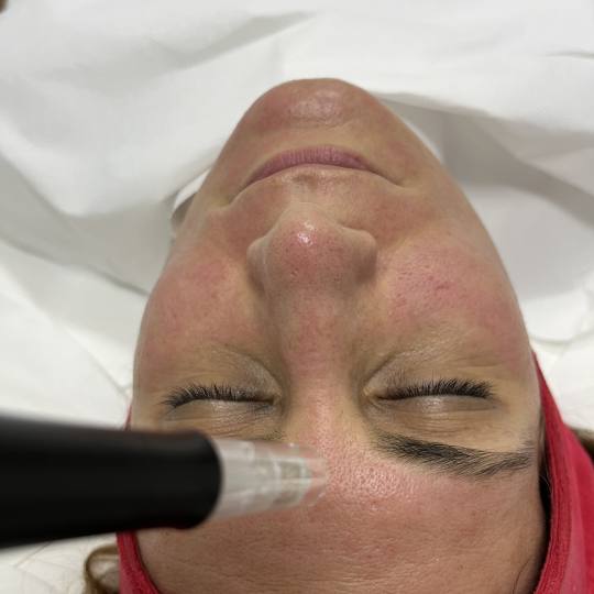 Estetski centar Vlahović #beograd Tretman lica Dermapen - podmladjivanje