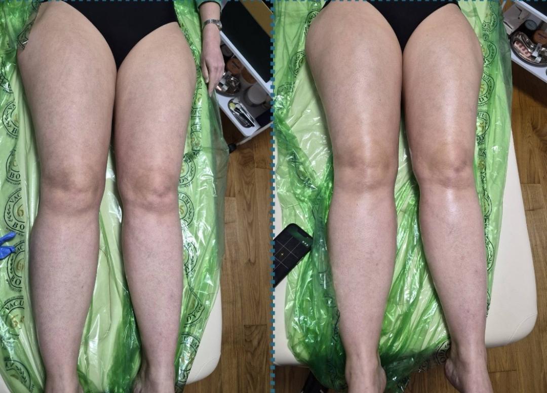 Vacum65body+lipomodelovanje jedne regije - Diamond beauty, Beograd Anticelulit masaža Masaža Anticelulit masaža, Beograd, Zemun Centar