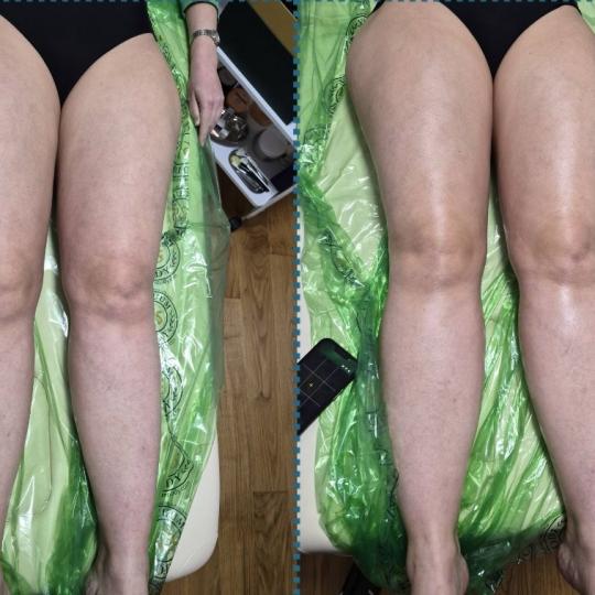 Diamond beauty #beograd Anticelulit masaža Vacum65body+lipomodelovanje jedne regije