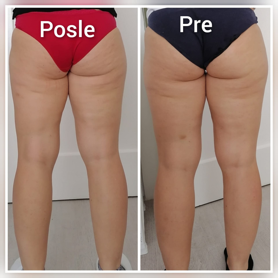 Skinlift Beauty Centar #nis Masaža za mršavljenje 4 tretmana kavitacije + 4 RF + 10 elektrostimulacije