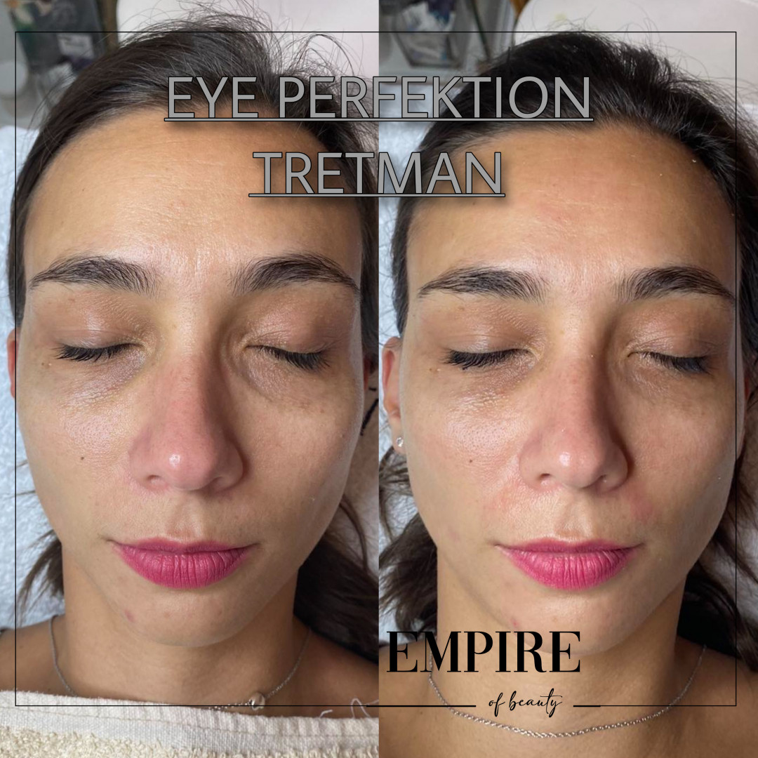 Guardian Beauty Centar & Milica Tepavac #beograd Tretmani regije oko očiju Eye Perfection tretman
