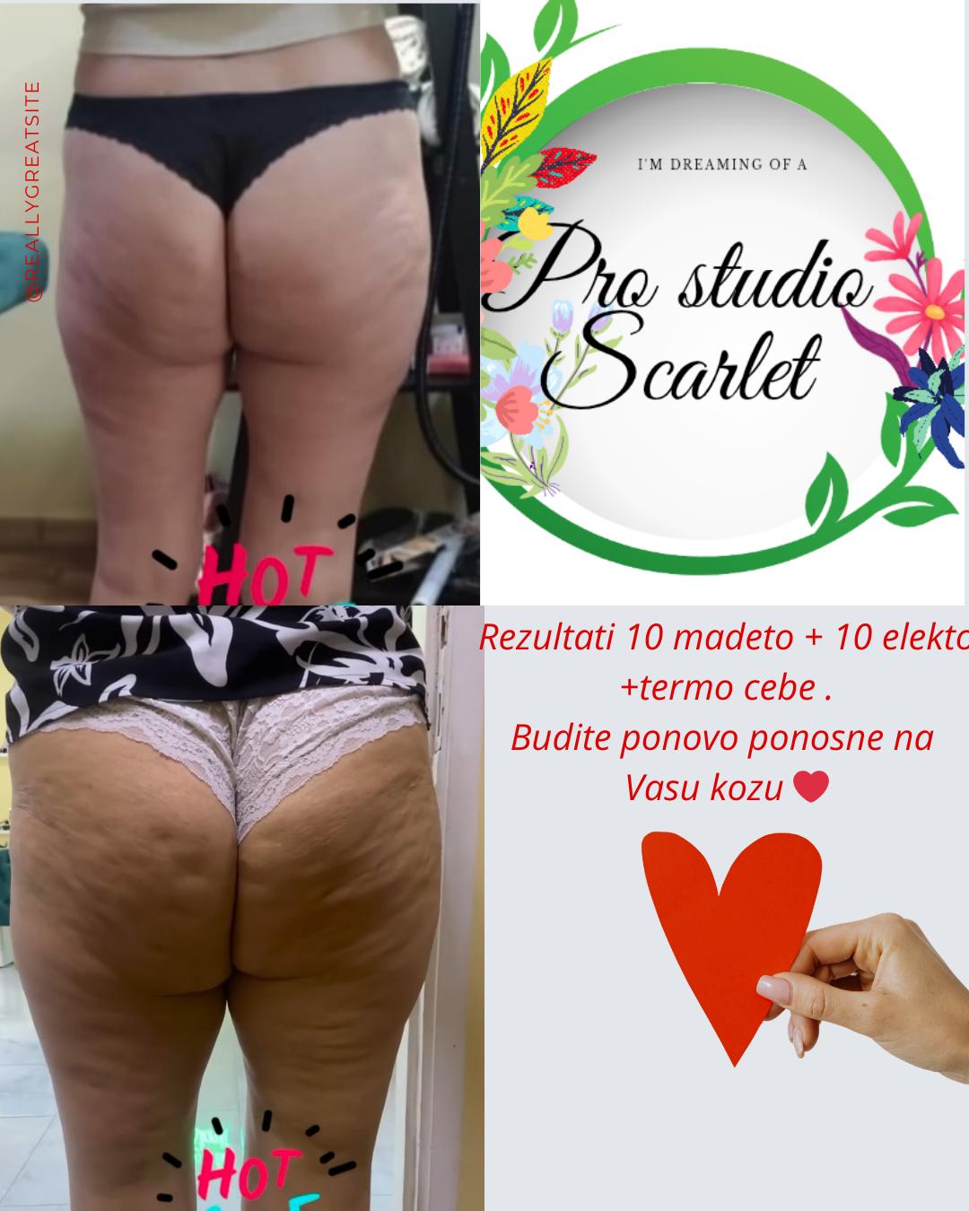 Pro studio Scarlet #beograd Anticelulit masaža Maderoterapija + elektrostimulacija mišića - paket od 10 maderoterapija