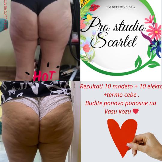 Pro studio Scarlet #beograd Anticelulit masaža Maderoterapija + elektrostimulacija mišića - paket