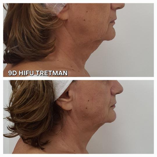 Beauty Vreme za mene #novisad Tretman lica 9D HIFU podbradak