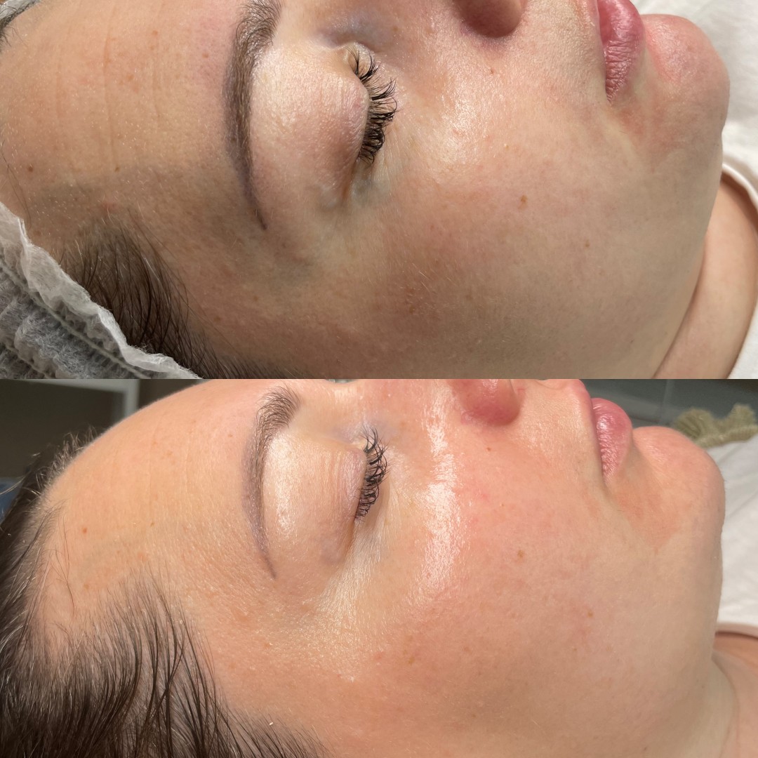 ReNova nutri & beauty #beograd Tretman lica Biološki antiage tretman lica