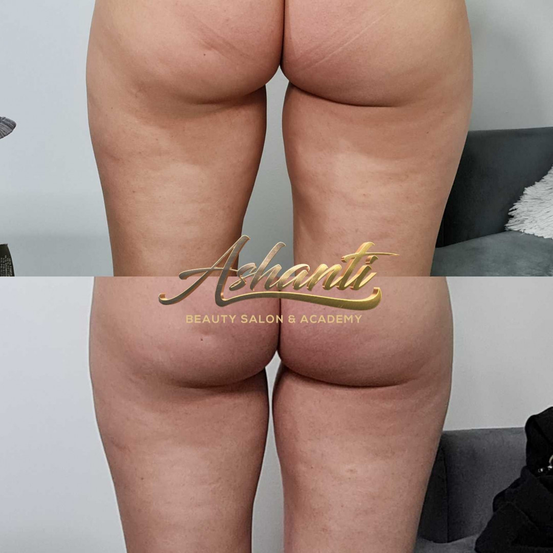 Ashanti Beauty Salon & Academy #beograd Kavitacija Ultrazvučna kavitacija - po regiji