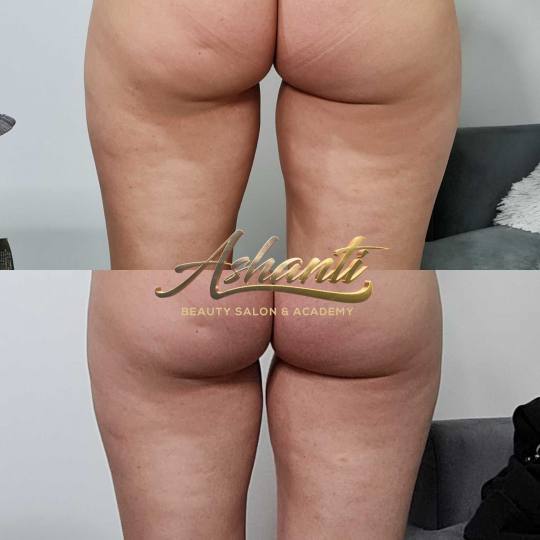 Ashanti Beauty Salon & Academy #beograd Kavitacija Ultrazvučna kavitacija - po regiji