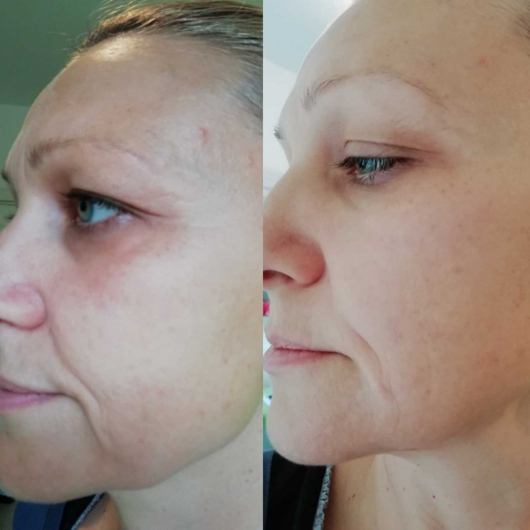 Olja Beauty #beograd Lifting / zatezanje kože HiFu tretman lica - po regiji