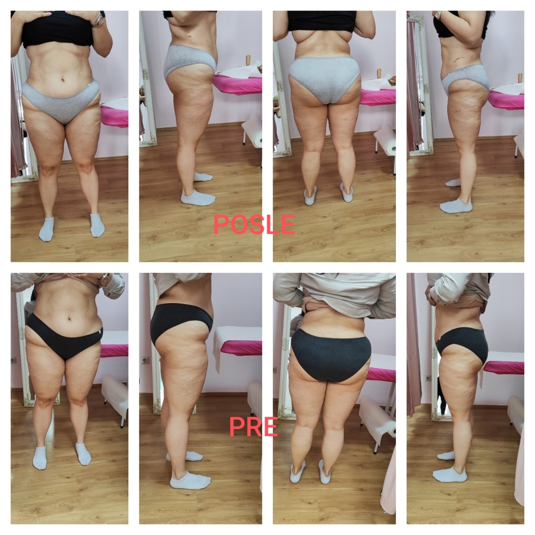 Mademoiselle Natalie studio #beograd Anticelulit LUX 10 maderoterapije+10 limfne drenaze+ brazilske madero+10 pakovanja