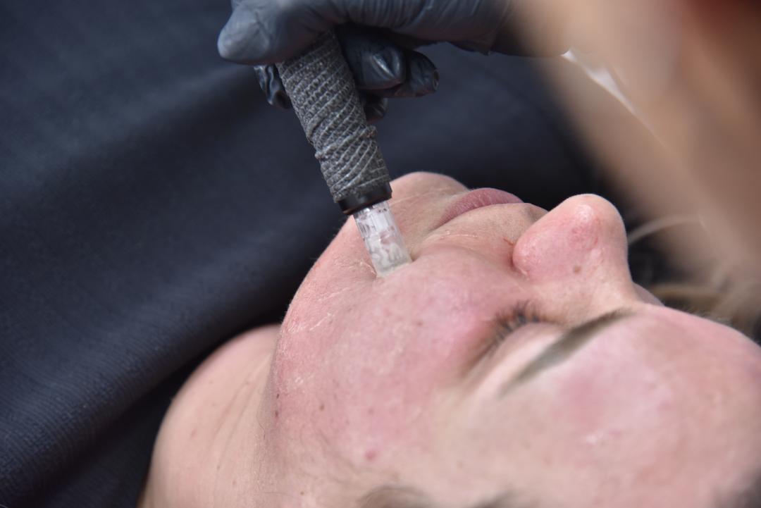 Microneedling tretman - lice - Belle Ana, Beograd Tretman lica Lice Tretman lica, Beograd, Vračar, Čubura, Crveni krst